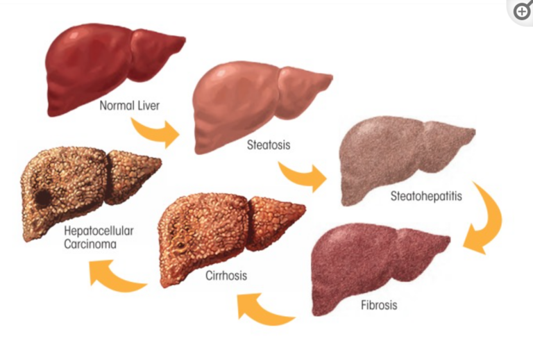 Spectrum of alcoholic liver disease