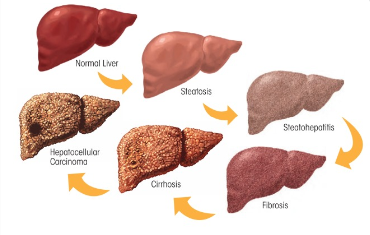 Spectrum of alcoholic liver disease.